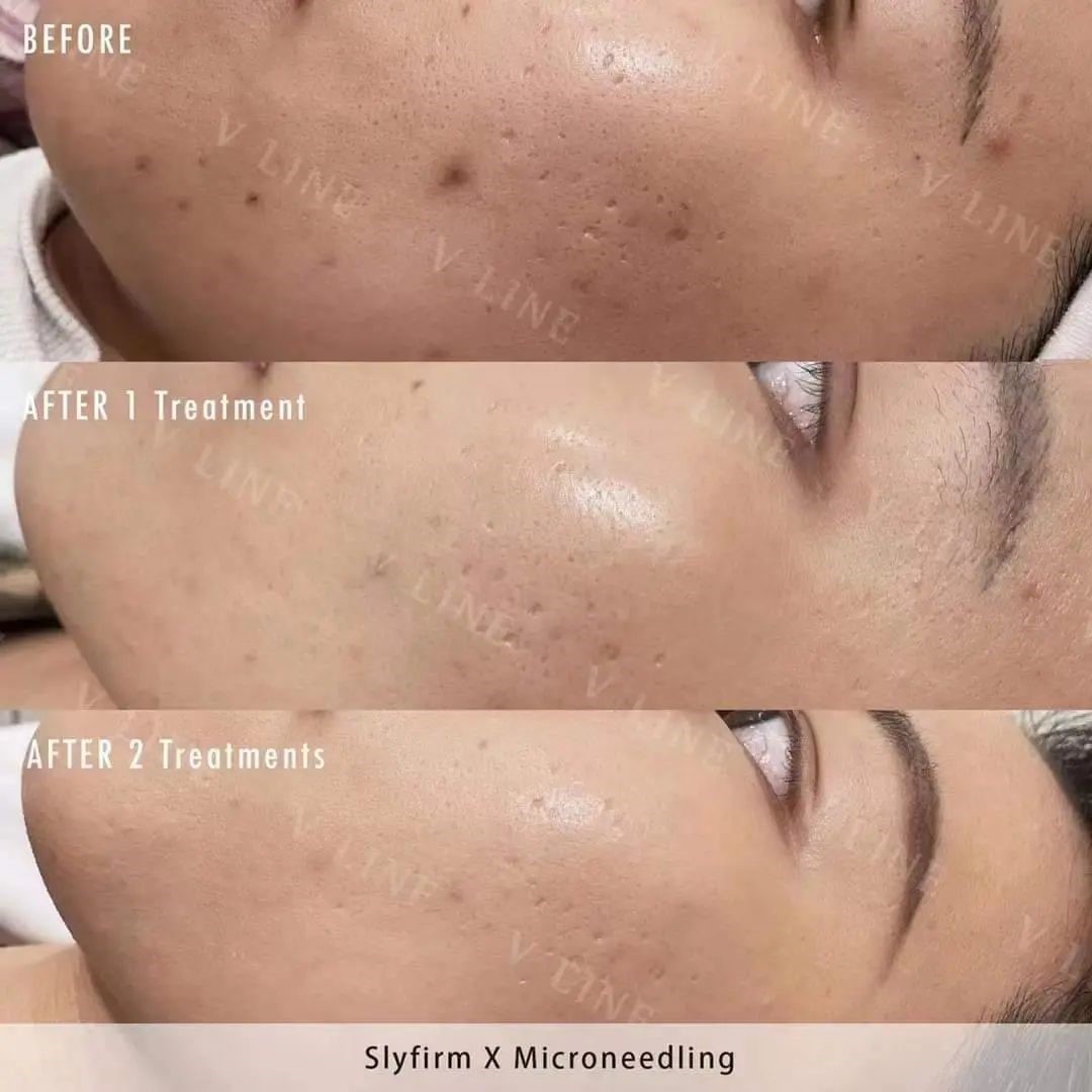 sylfirm x Results of 2 sessions of Radio frequency microneedling for the treatment of acne scars done at VLine Cosmetic Clinic Toronto