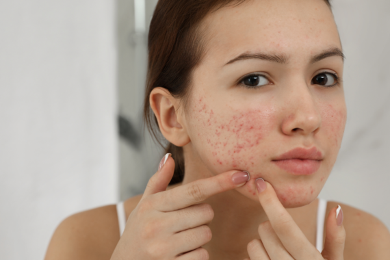 What Makes Hydrafacial the Best Acne Facial