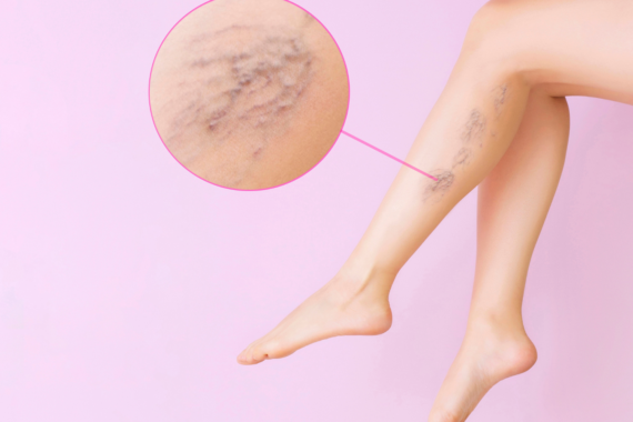 Why Am I Getting Spider Veins