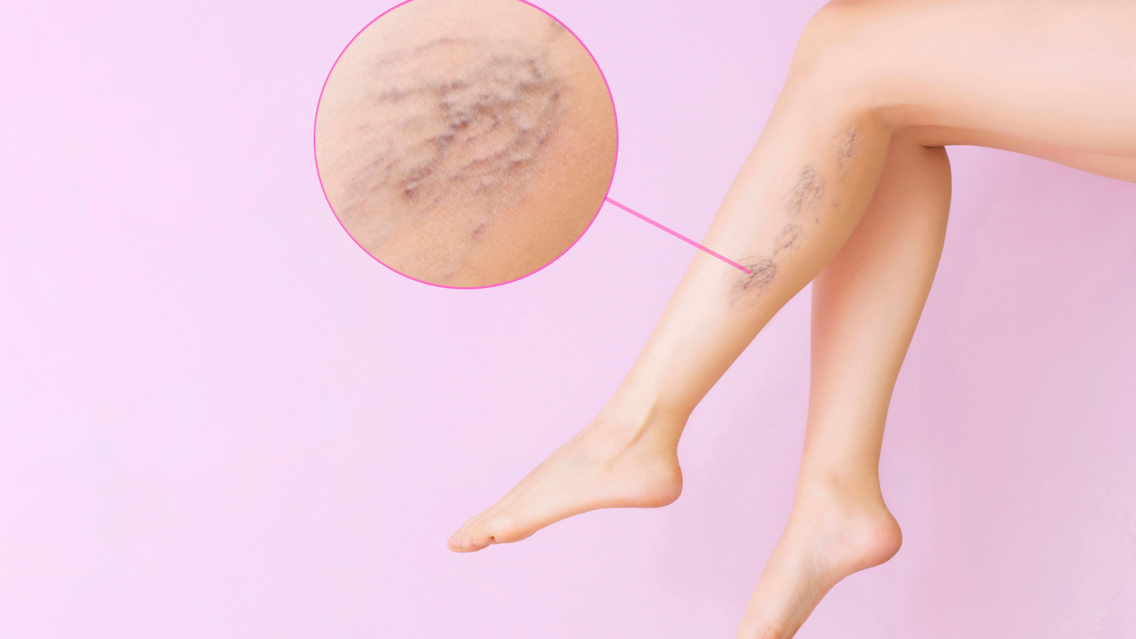 Why Am I Getting Spider Veins