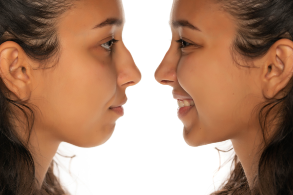 Nonsurgical Nose Job