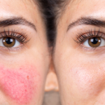 Rosacea