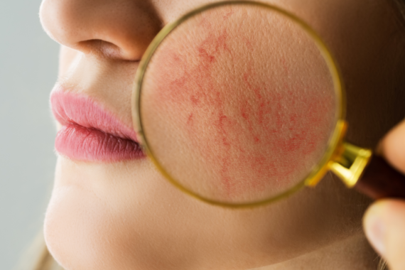 The Most Effective Treatment For Rosacea In Toronto