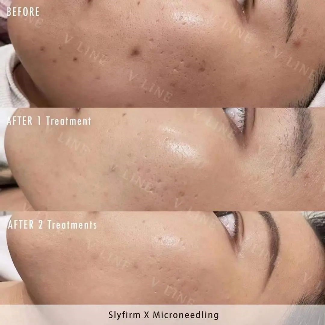 Results of 2 sessions of Radio frequency microneedling for the treatment of acne scars done at VLine Cosmetic Clinic Toronto