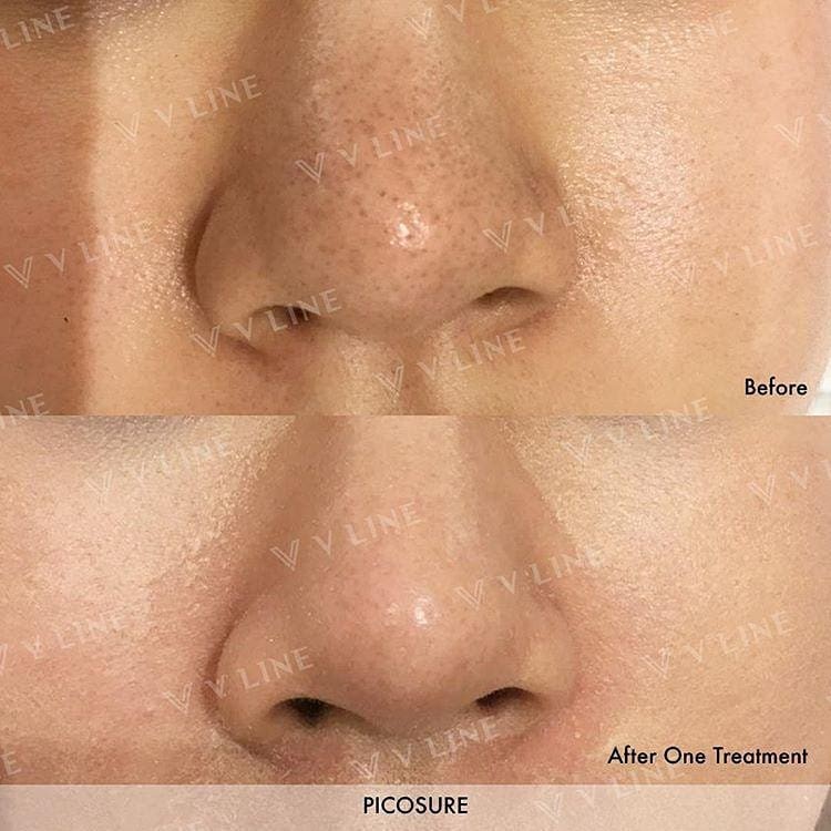 Pore shrinking with Picosure